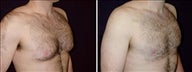26 year old male, male breast reduction
