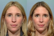 Rhinoplasty