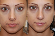 Non surgical nose job