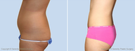 Liposuction