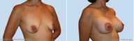 Breast lift