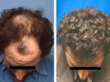 Hair transplant