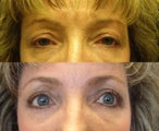 Eyelid Surgery