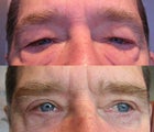 Eyelid Surgery
