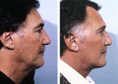 Facelift
