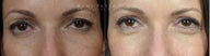 Before and After of Upper Eyelid Blepharoplasty