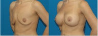 Breast Augmentation