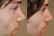 Non surgical nose job