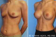Breast Implants