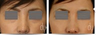 Eye Bags Treatment