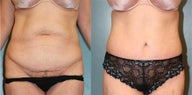 Tummy tuck