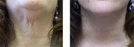 Neck lift