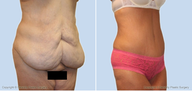 Tummy tuck
