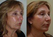 Neck lift