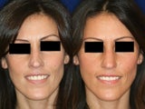 Non surgical nose job