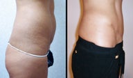 Tummy Tuck(Abdominoplasty)