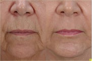 Fractional laser