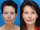 Facelift