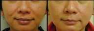 Fractional CO2 Laser
