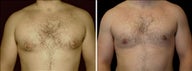 31 year old male, male breast reduction