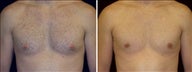29 year old male, male breast reduction