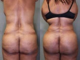 55 Year Old Female Treated for Unwanted Fat with SmartLipo  and Vaser Laser 