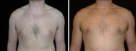 23 year old male, male breast reduction