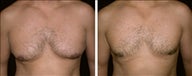 42 year old male, male breast reduction