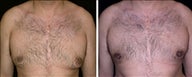 30 year old male, male breast reduction