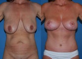 Mommy Makeover