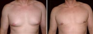 36 year old male, male breast reduction