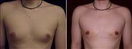 21 year old male, male breast reduction