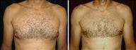 33 year old male, male breast reduction