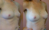 Breast Implants
