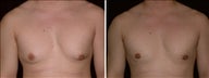 24 year old male, male breast reduction