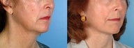 Facelift