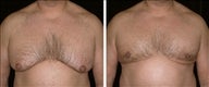 48 year old male, male breast reduction