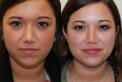 Neck Liposuction, and Silicone Lip Injections.