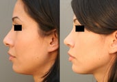 Septoplasty