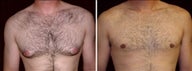 29 year old male, male breast reduction
