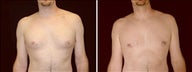 30 year old male, male breast reduction