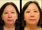 Juvederm