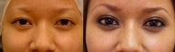 Asian eyelid surgery for asymmetry