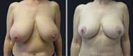 Breast Reduction