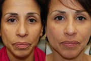 Silikon-1000 and Botox.