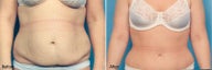 Tummy Tuck