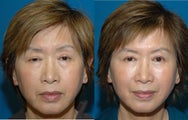 Fat transfer cheeks with lid surgery