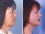 Facelift