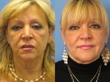 Exilis skin tightening of face