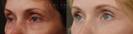 Before and After Bilateral upper eyelid blepharoplasty with  ptosis repair